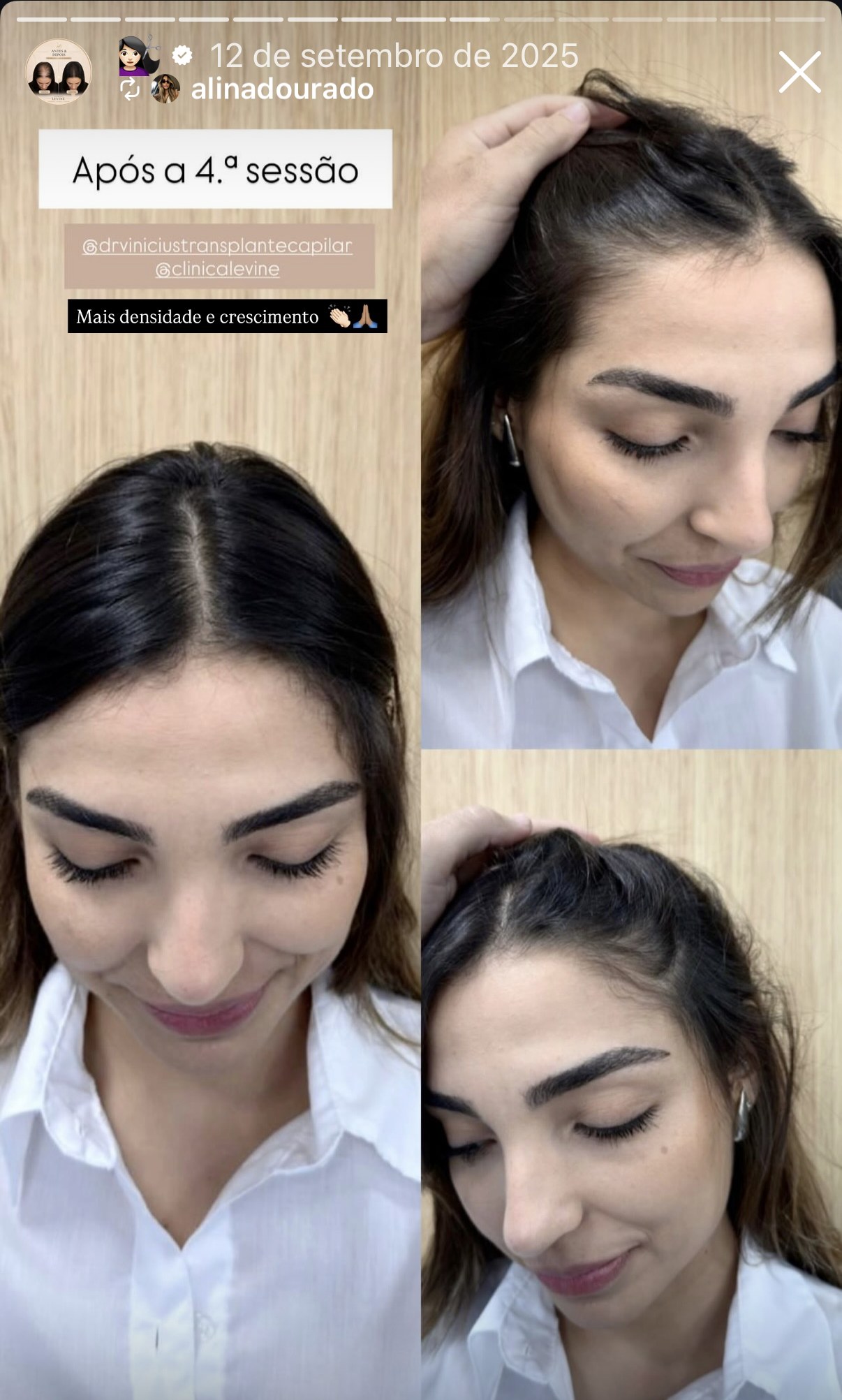 Print do Stories: @alinadourado mostrando mais densidade e crescimento após a 4ª sessão