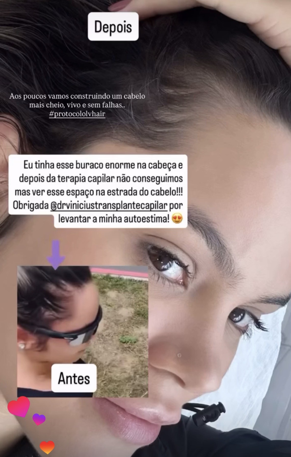 Print do Stories: @larissafiatkoski mostrando o resultado depois da terapia capilar, com registro de antes