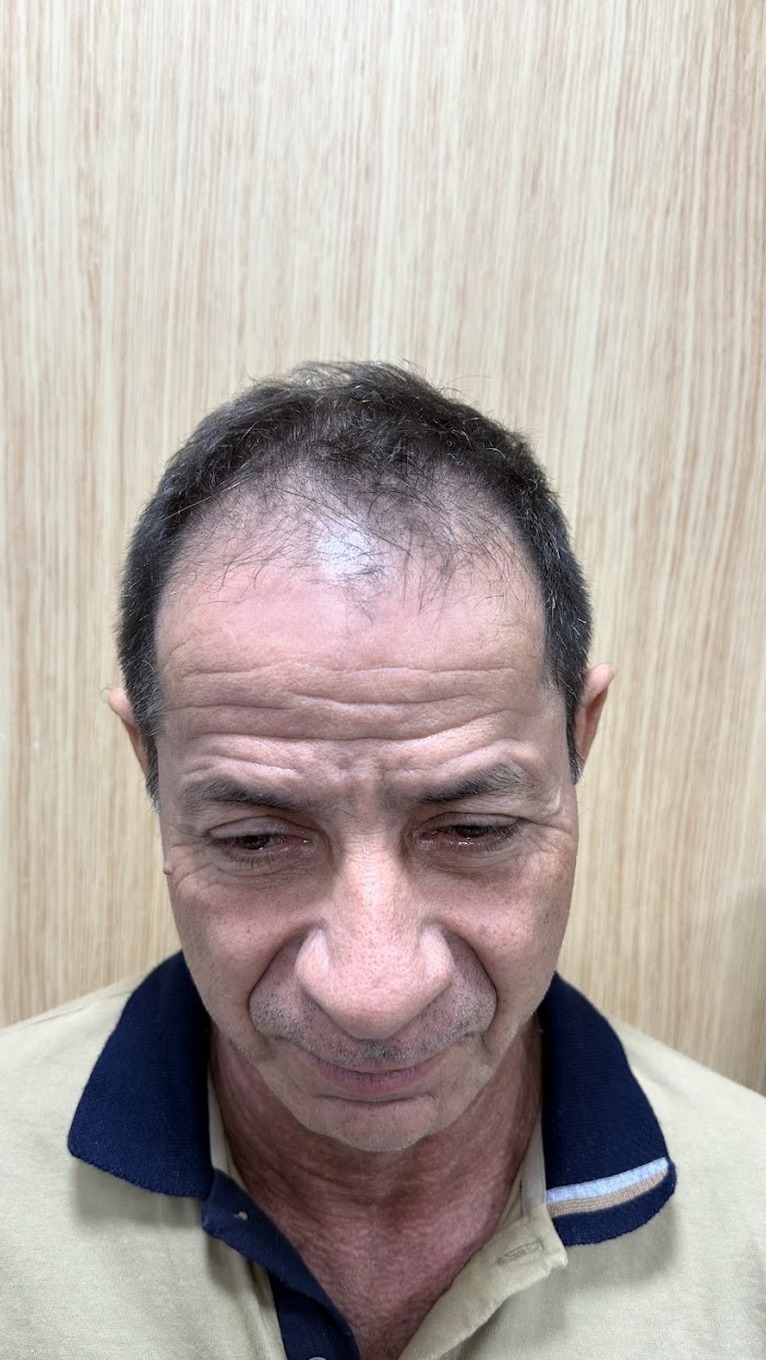 Antes do Protocolo LV Hair, paciente 1, vista frontal