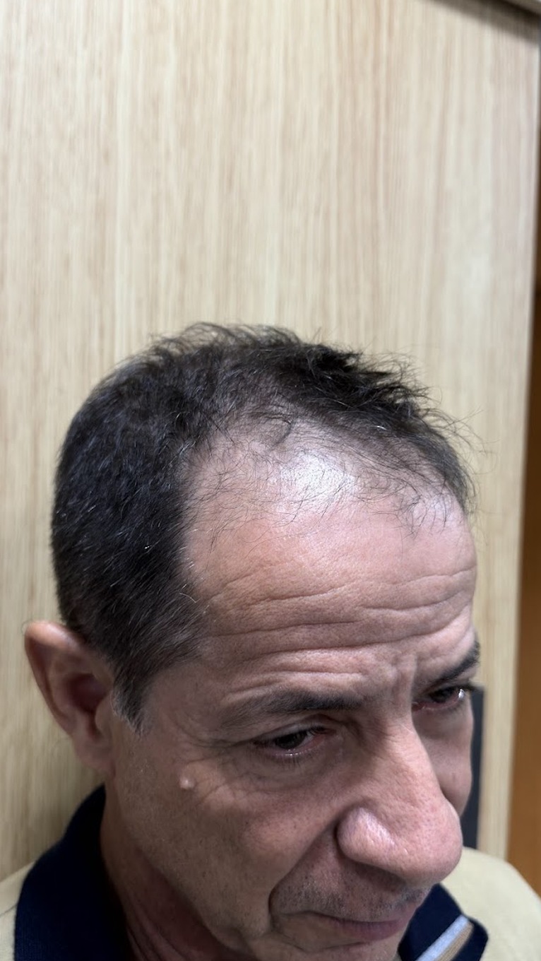 Antes do Protocolo LV Hair, paciente 1, vista de perfil