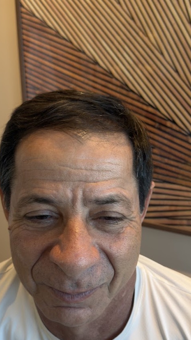 Depois do Protocolo LV Hair, paciente 1, vista frontal