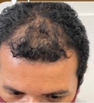 Antes do Protocolo LV Hair, paciente 4