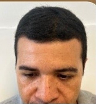 Depois do Protocolo LV Hair, paciente 4