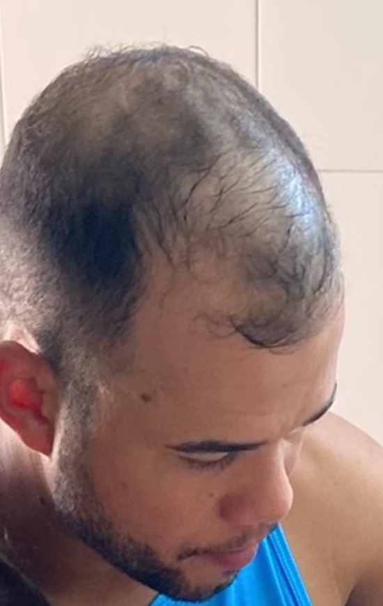 Antes do Protocolo LV Hair, paciente 3, outro registro