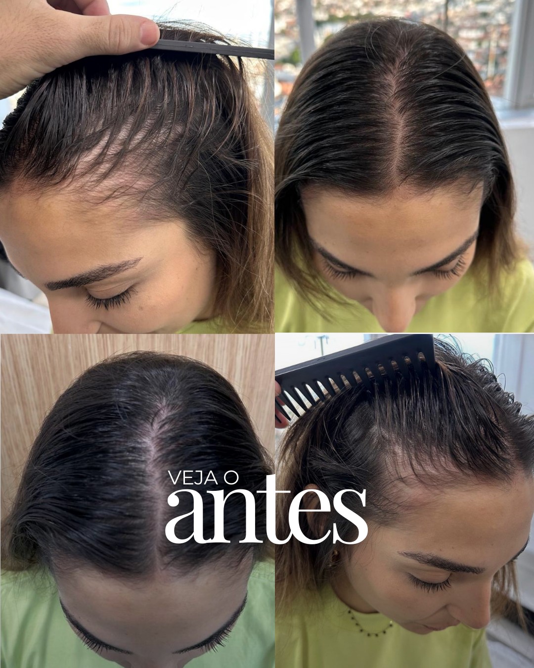 Antes do Protocolo LV Hair, paciente 6